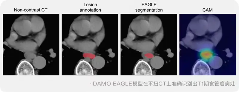 阿里达摩院发布食管癌筛查AI模型DAMO EAGLE，平扫CT即可识别早期病变，登上Nature Medicine